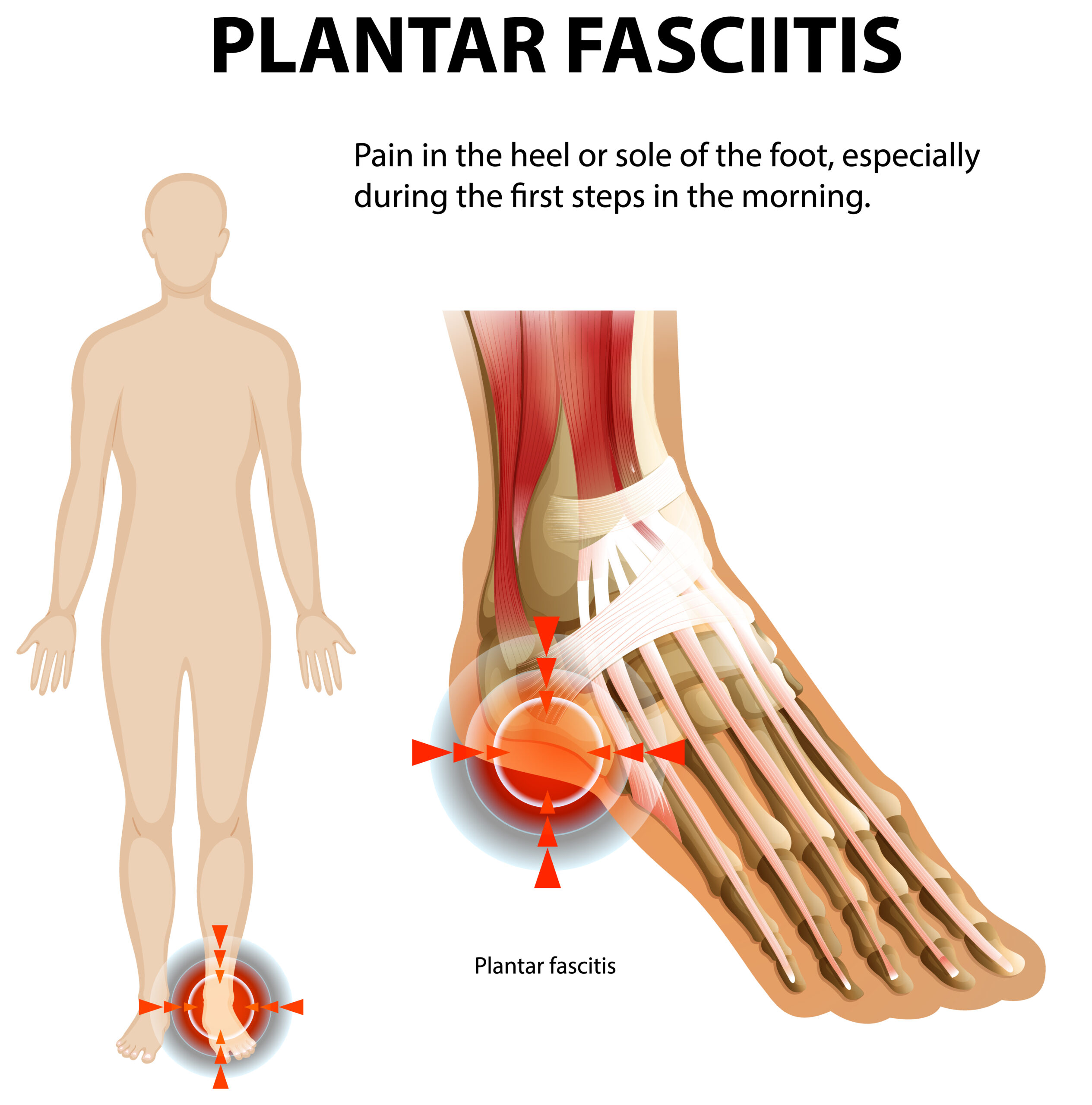 plantar fasciitis heel spur, heel pain
