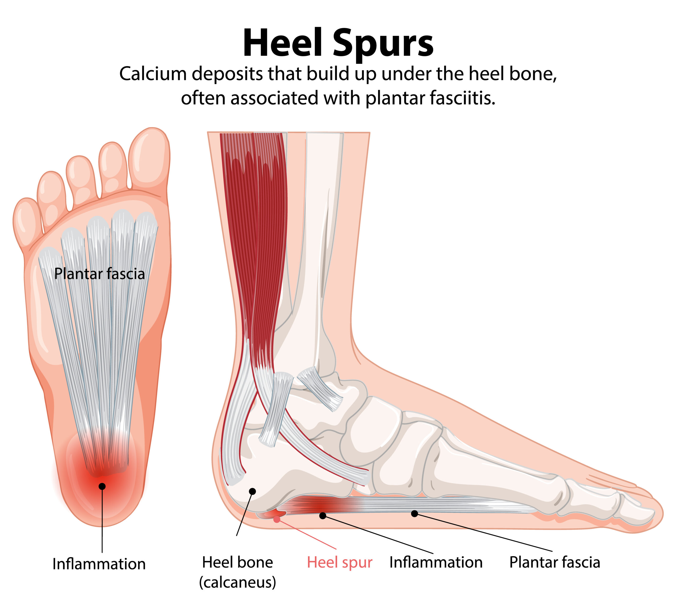 heel spur, plantar fasciitis