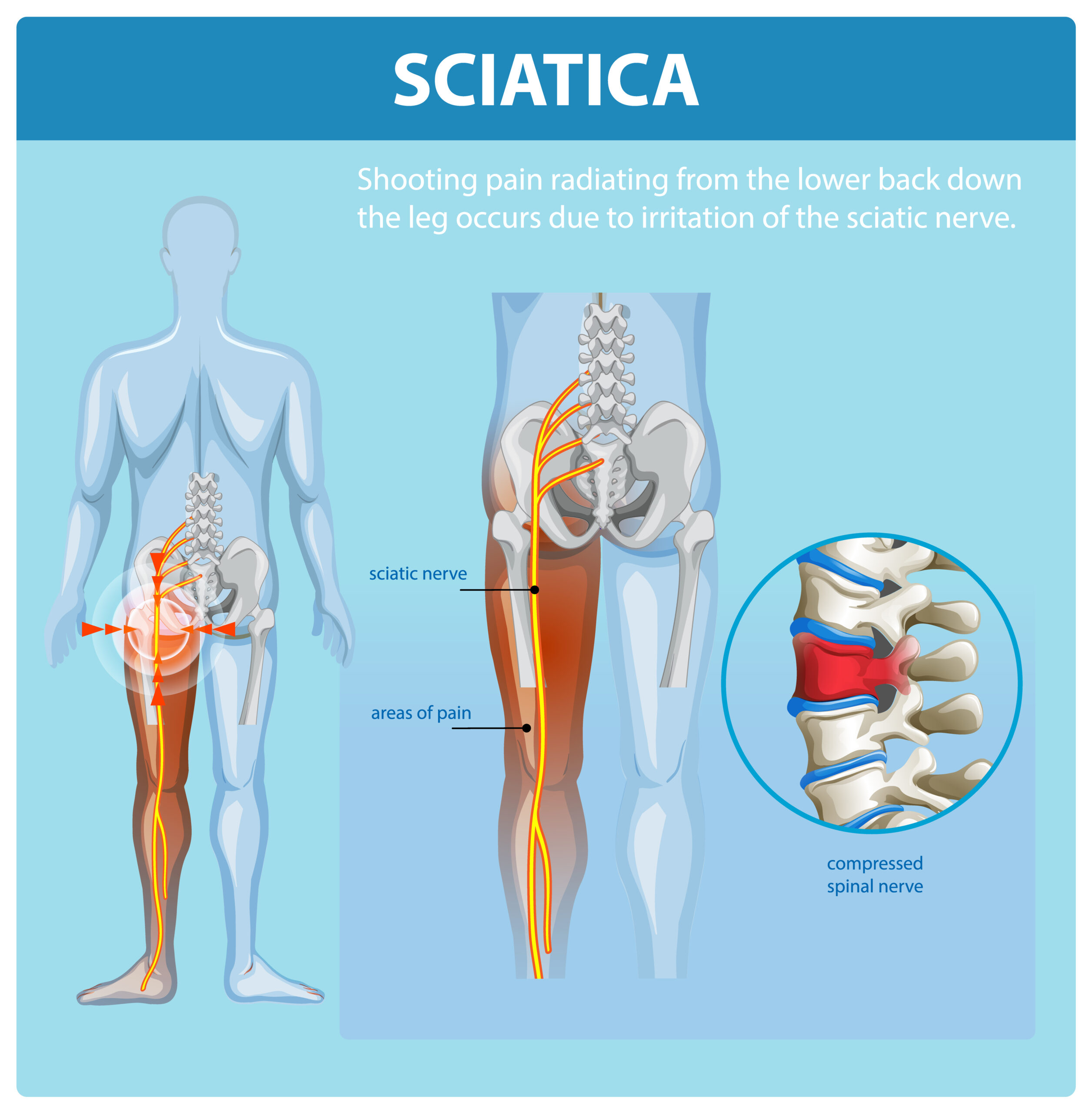 sciatica